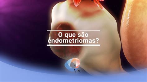 espessamento de endometrio cid 10